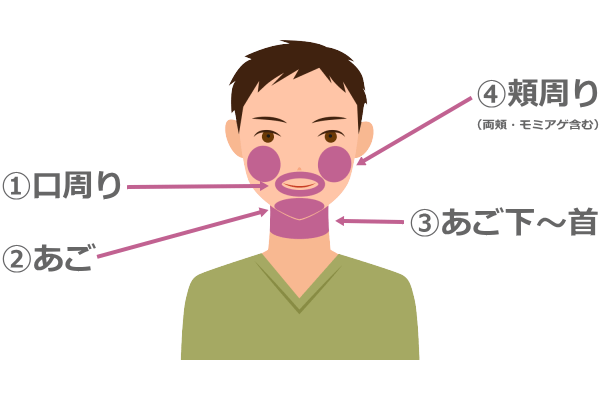 ヒゲ脱毛の部位