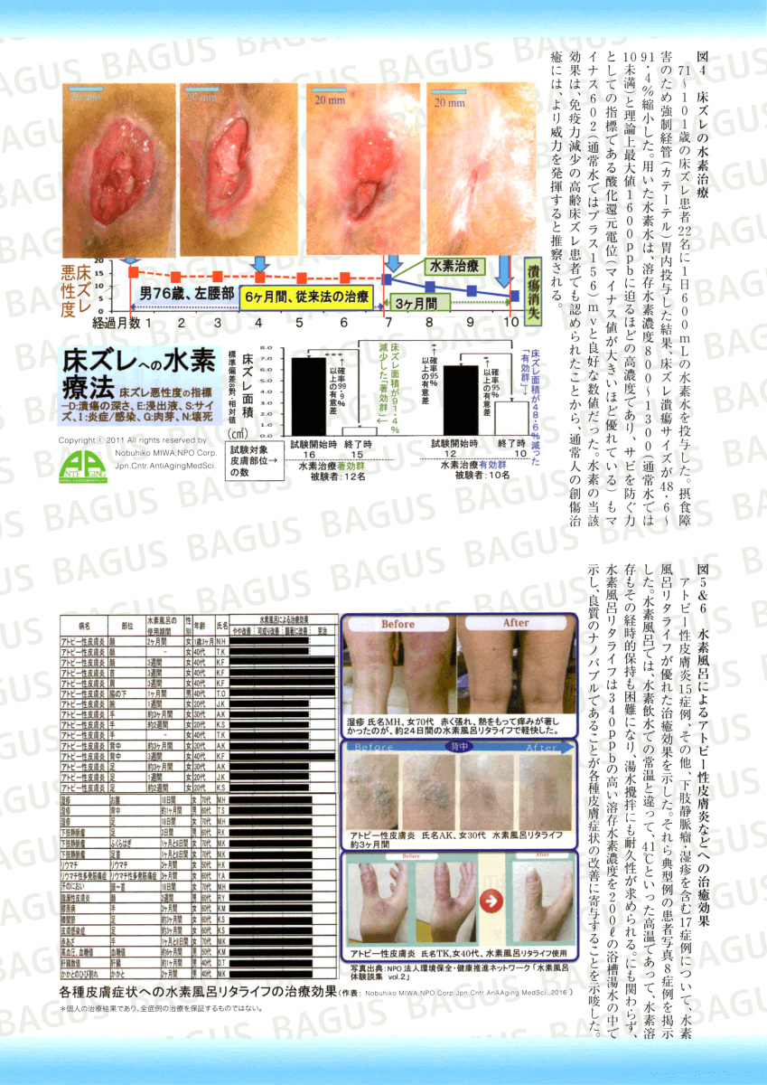 水素風呂でアトピーが改善