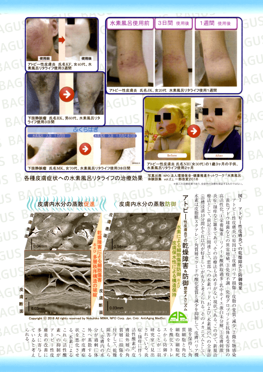 静脈瘤等の皮膚症状が改善